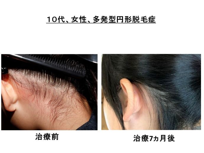 円形脱毛症　病院